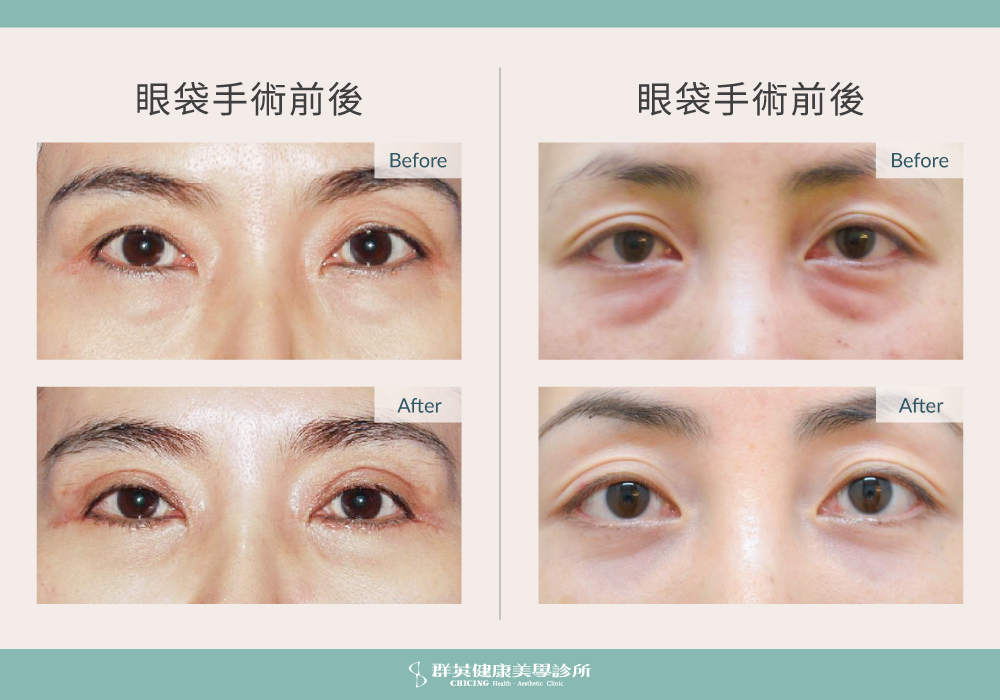 侯憲棋醫師 | 眼整形案例分享